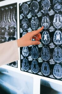 brain fog